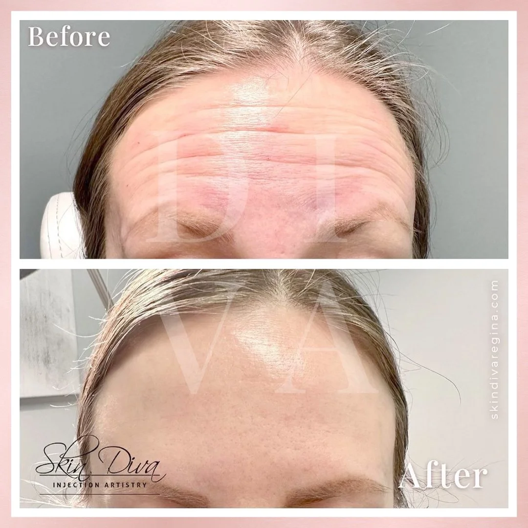 Forehead Lines