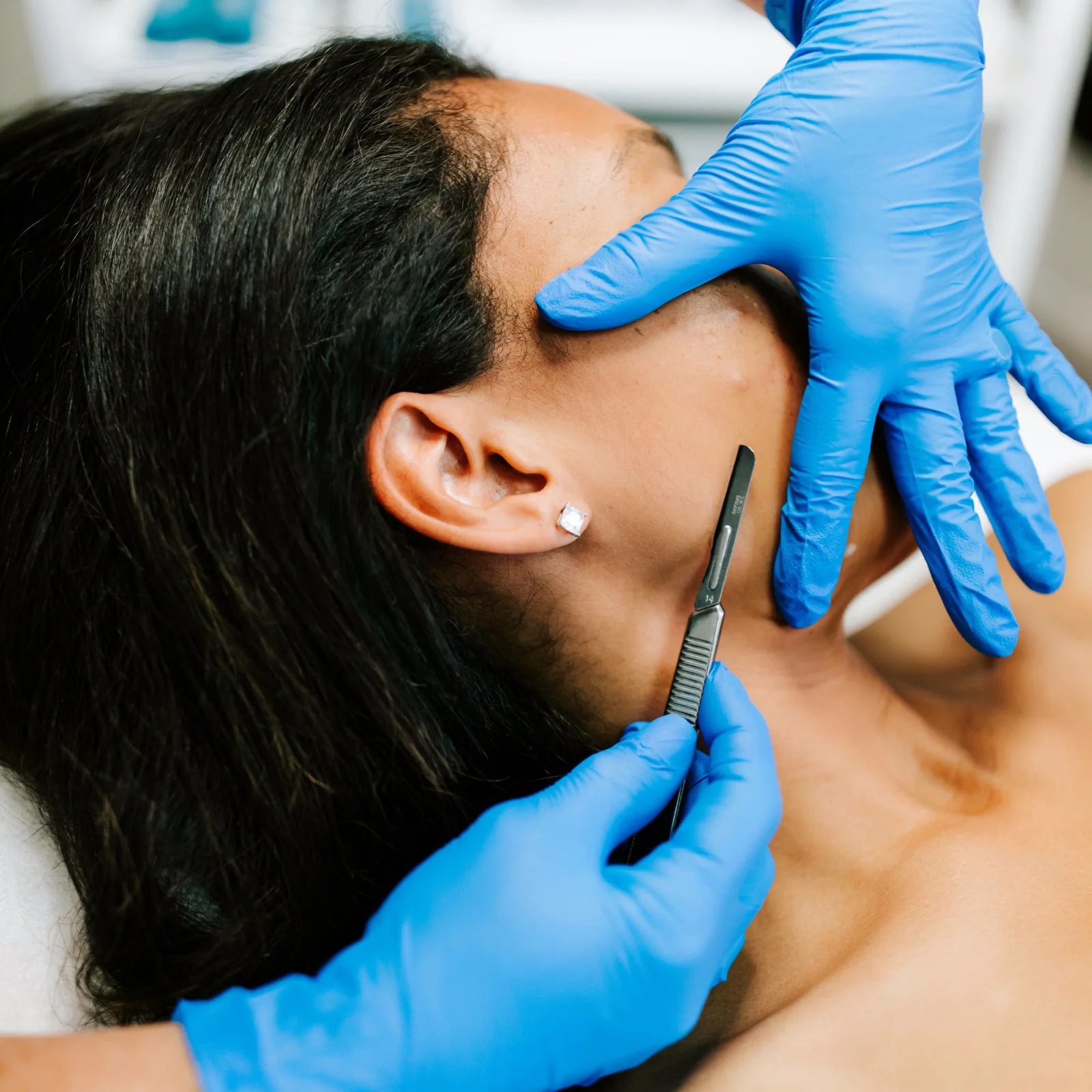 Dermaplaning in Regina: Peach Fuzz, Makeup and Sensitive Skin