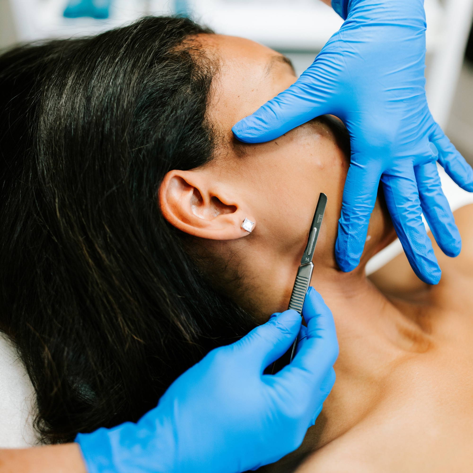 Dermaplaning