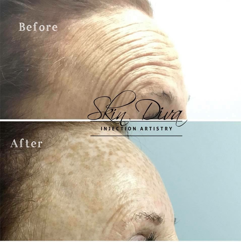Skin Diva forehead line smoothing before and after