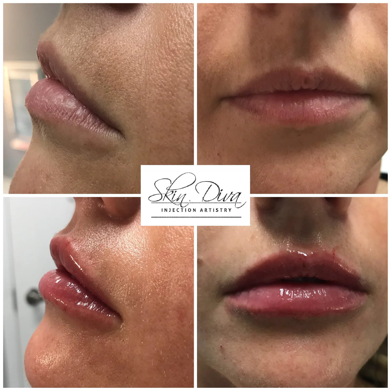 Skin Diva lip enhancement before and after