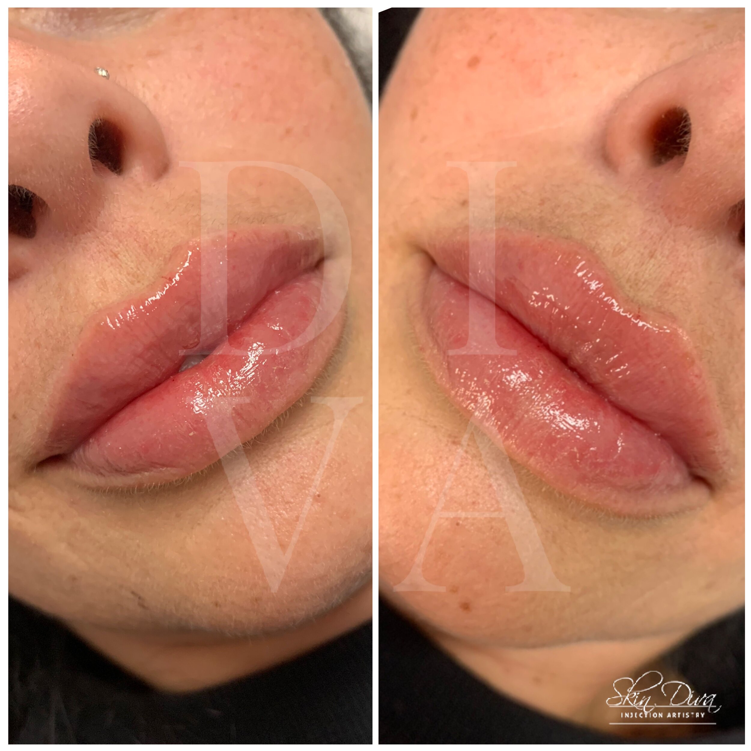Skin Diva natural lip filler result