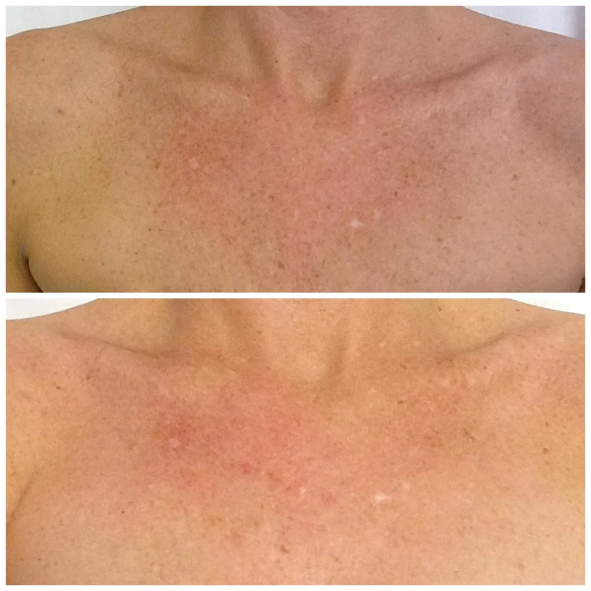 IPL comparison of chest pigmentation before treatment at the top and after treatment at the bottom
