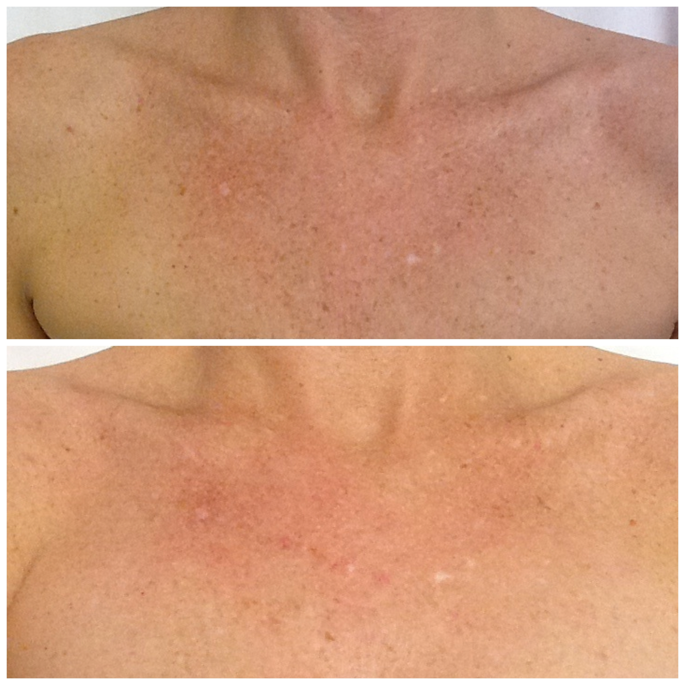 IPL comparison of chest pigmentation before treatment at the top and after treatment at the bottom