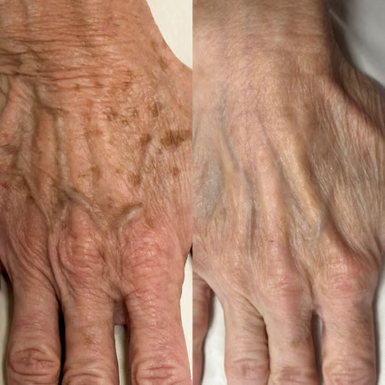Side-by-side IPL comparison of the back of a hand before treatment on the left and after treatment on the right