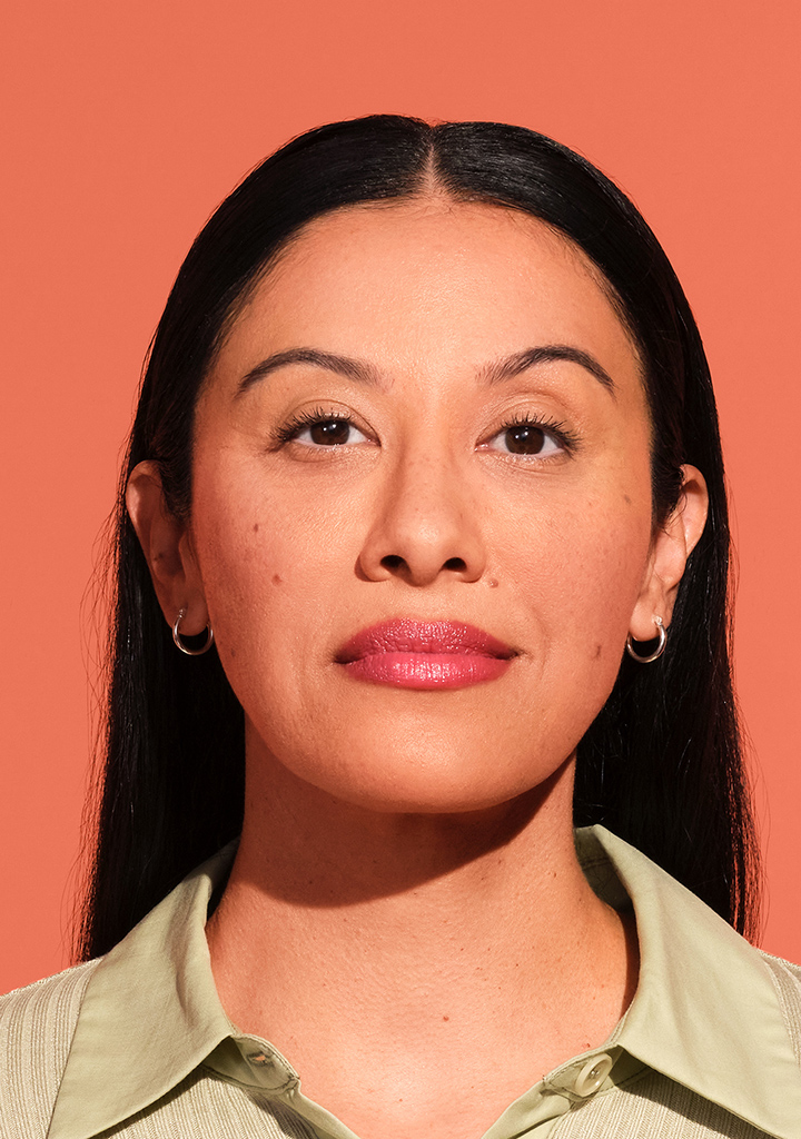A patient treated with the Juvéderm collection of hyaluronic acid fillers by Allergan Aesthetics
