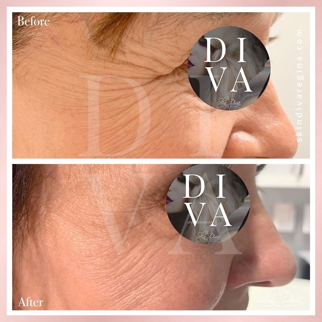 Neuromodulator before and after result 2 at Skin Diva Regina