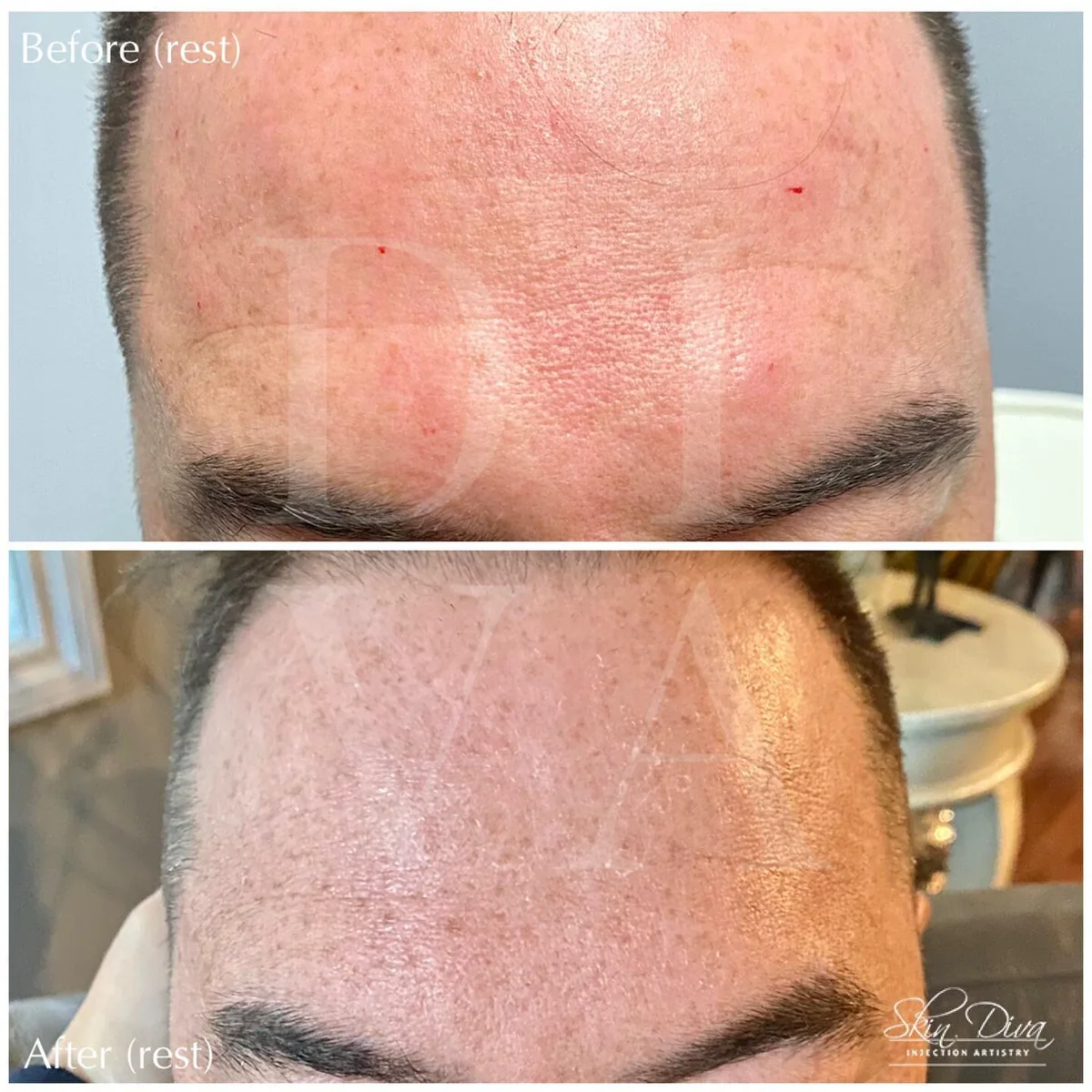 Before and after forehead line smoothing treatment