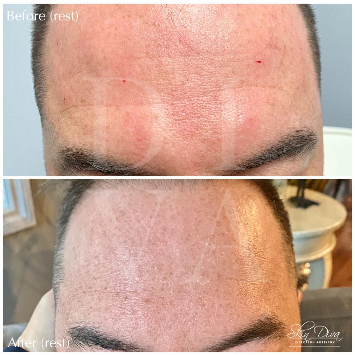 Neuromodulator before and after result 3 at Skin Diva Regina