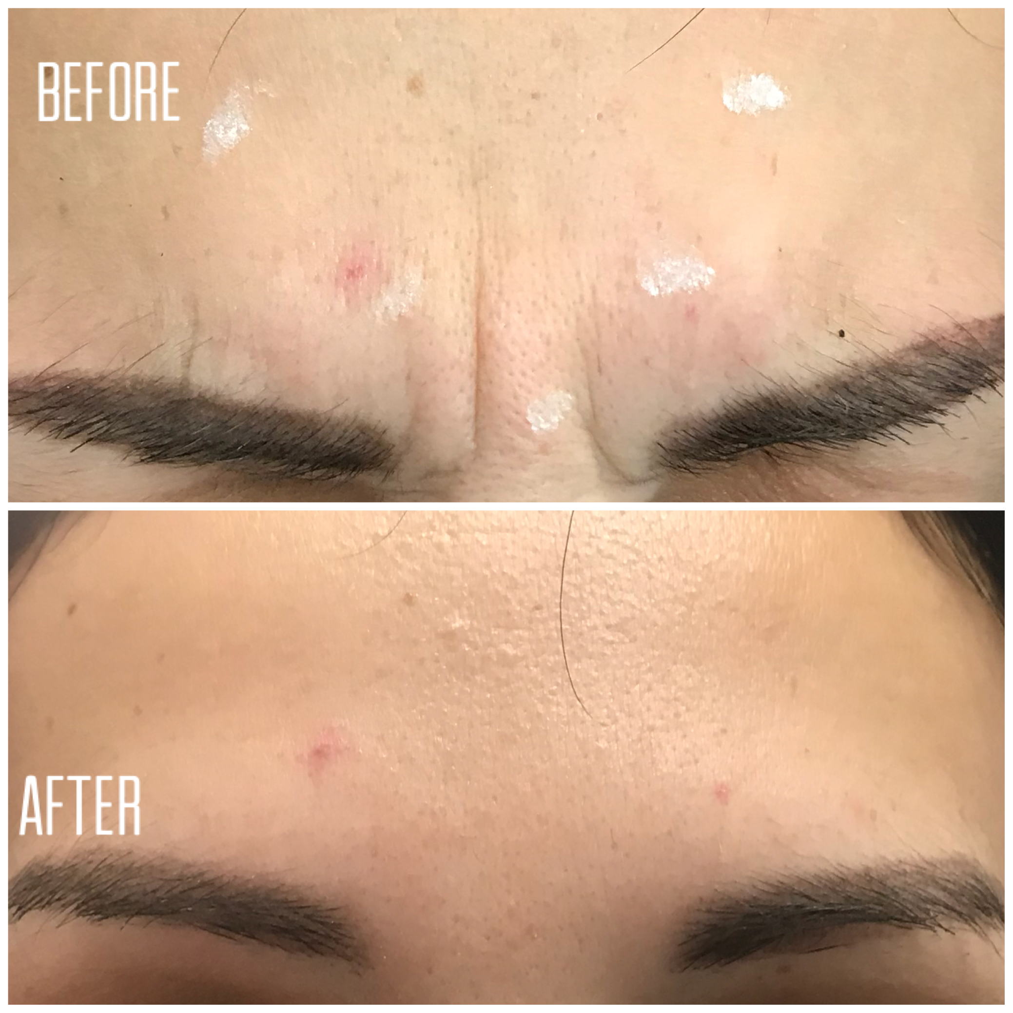 Neuromodulator before and after result 7 at Skin Diva Regina