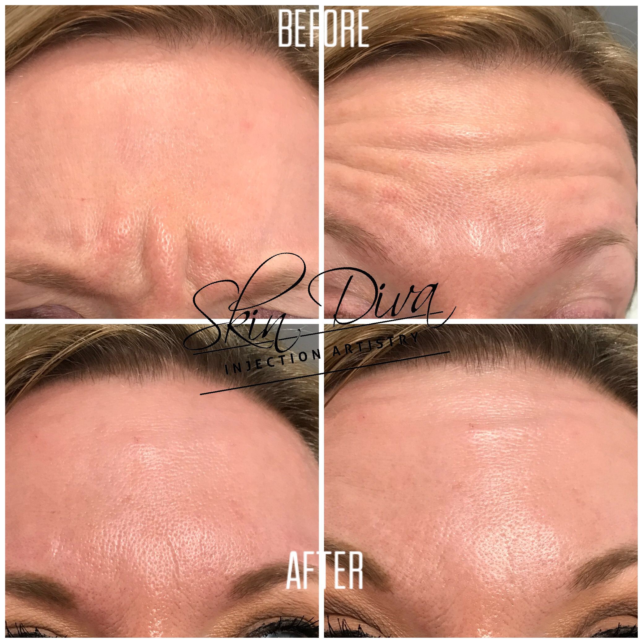 Neuromodulator before and after result 8 at Skin Diva Regina