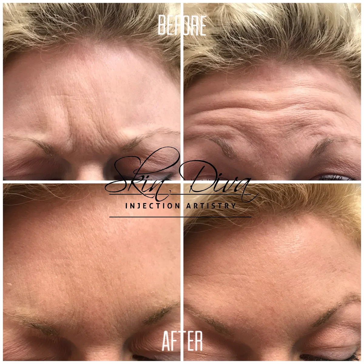 Neuromodulator before and after result 9 at Skin Diva Regina