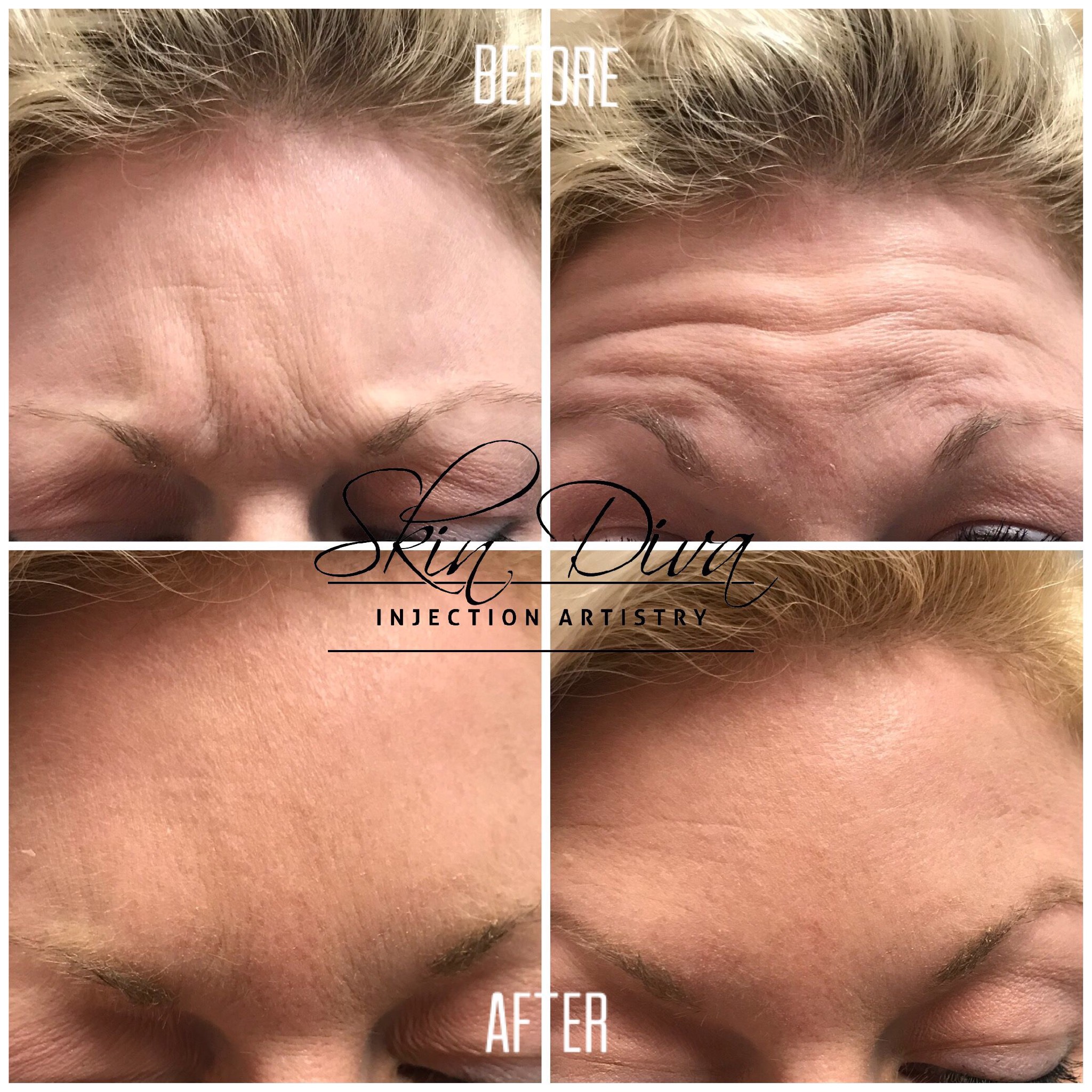 Neuromodulator before and after result 9 at Skin Diva Regina