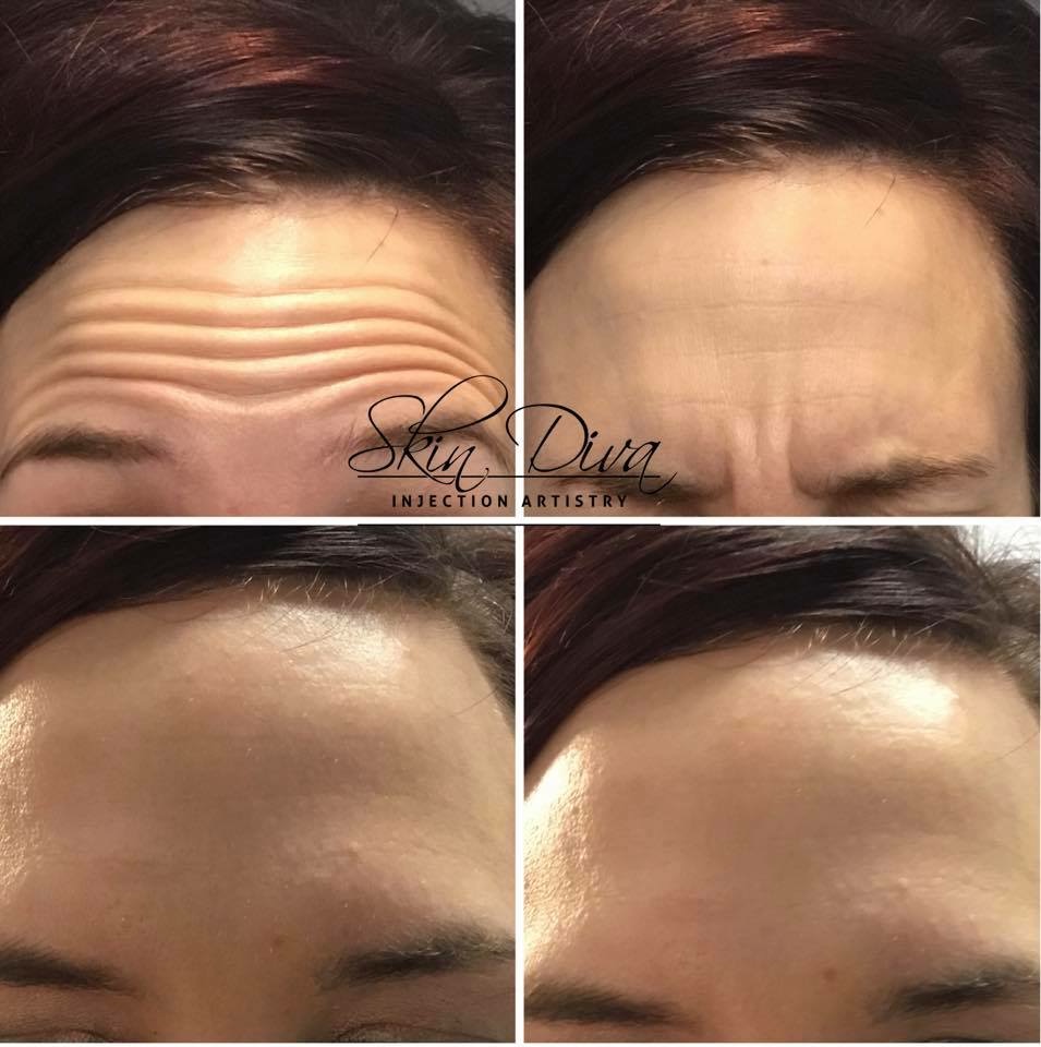Neuromodulator before and after result 10 at Skin Diva Regina