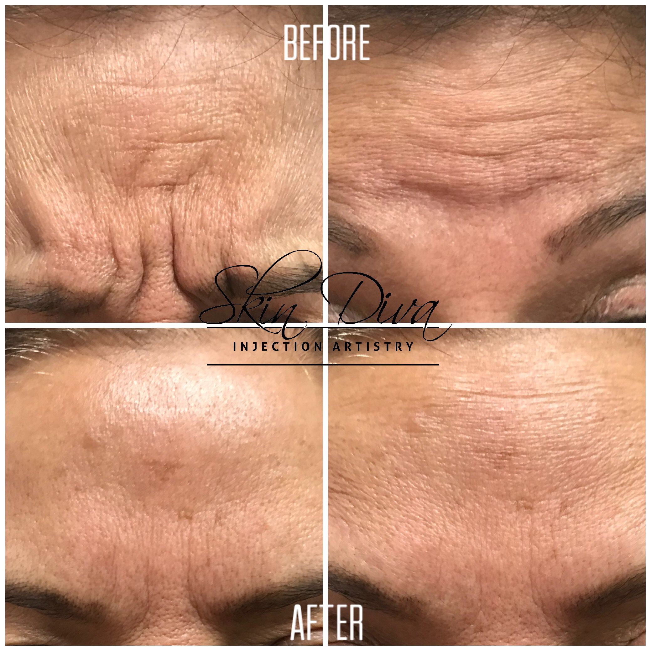 Neuromodulator before and after result 12 at Skin Diva Regina