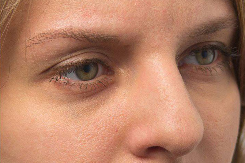Upper eye area, after Plexr treatment