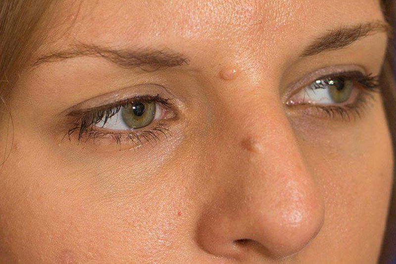 Upper eye area, before Plexr treatment
