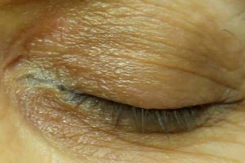 Eyelid lesion area, after Plexr treatment
