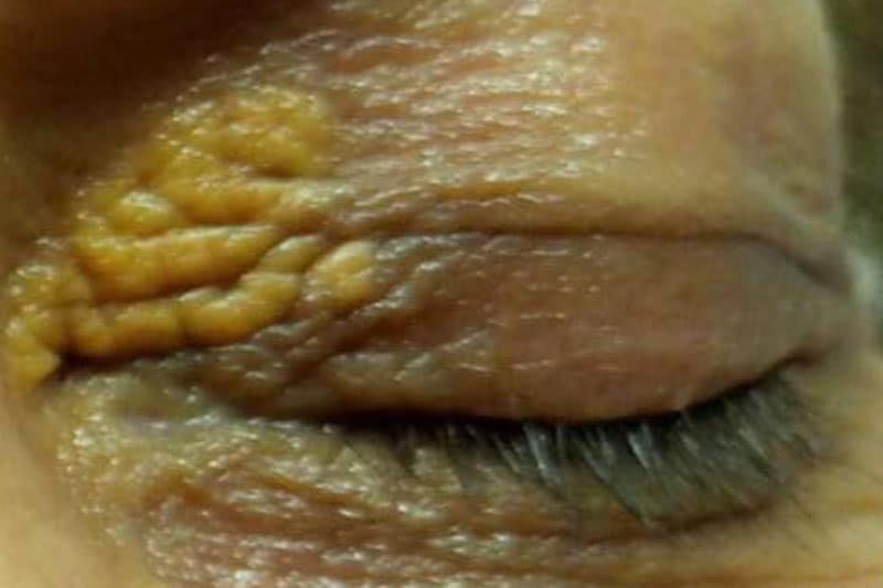 Eyelid lesion area, before Plexr treatment