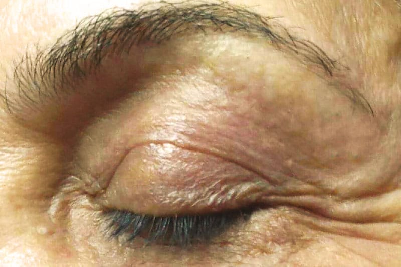 Upper eyelid, after Plexr treatment