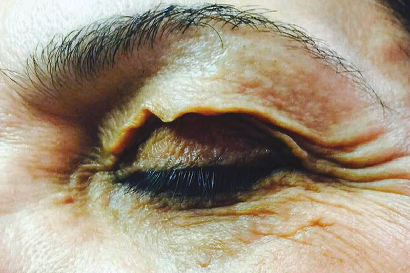 Upper eyelid, before Plexr treatment