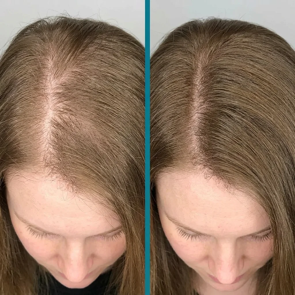 Side-by-side PRP hair restoration comparison showing fuller-looking light-brown hair