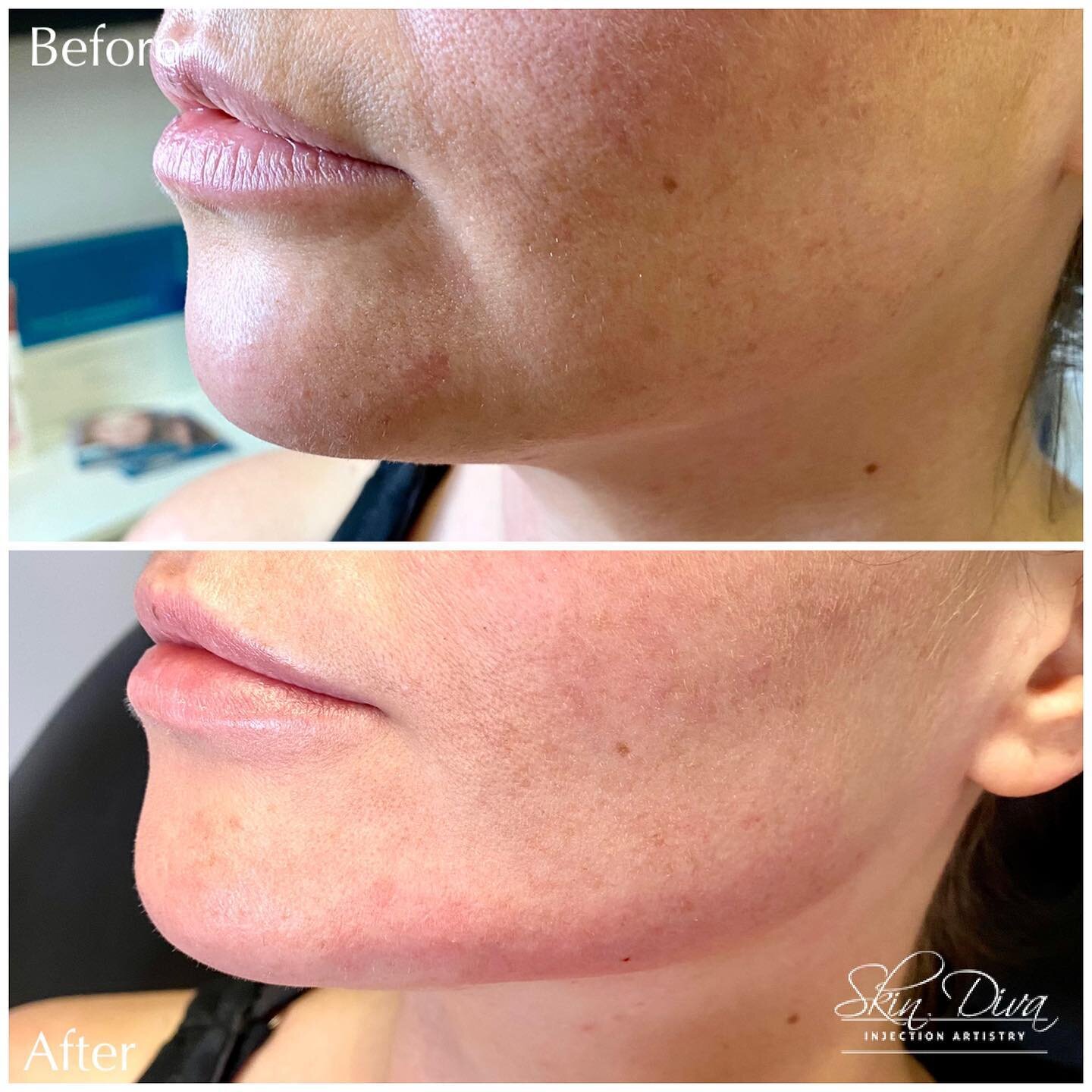Before and after natural-looking lip enhancement