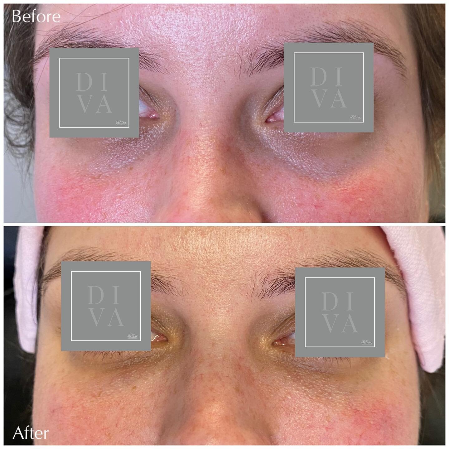 Before and after treatment of the under-eye area, front view