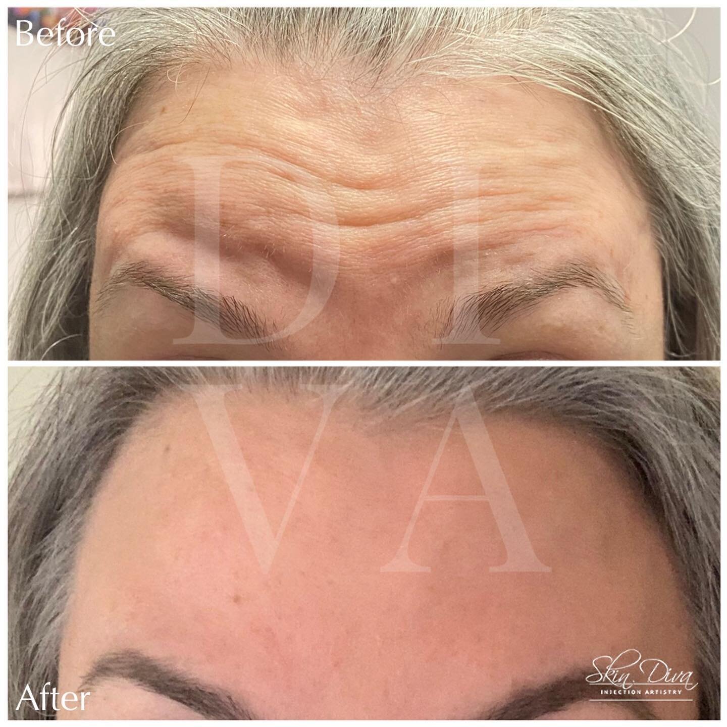 Before and after forehead wrinkle treatment on mature skin