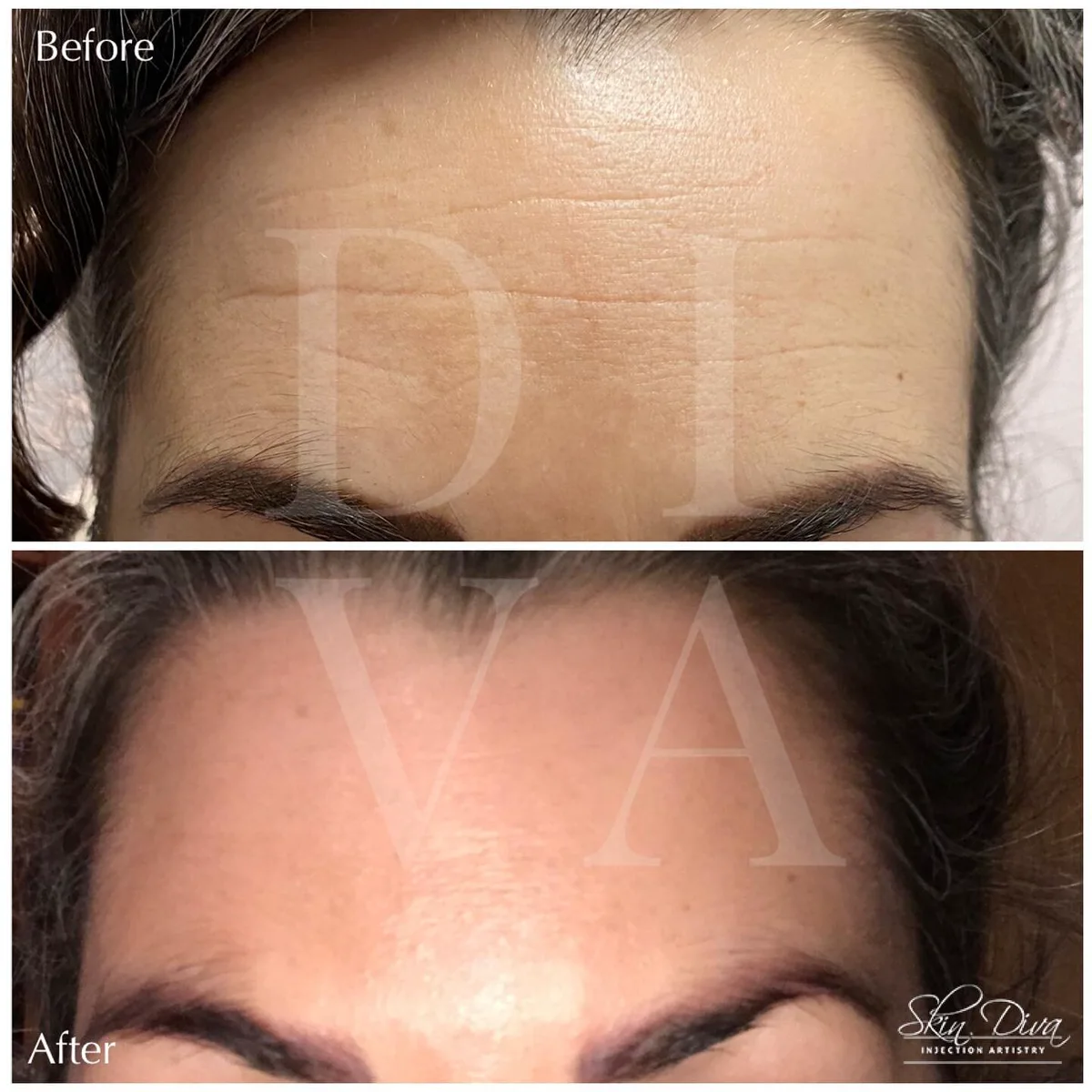 Before and after lip filler treatment on mature lips