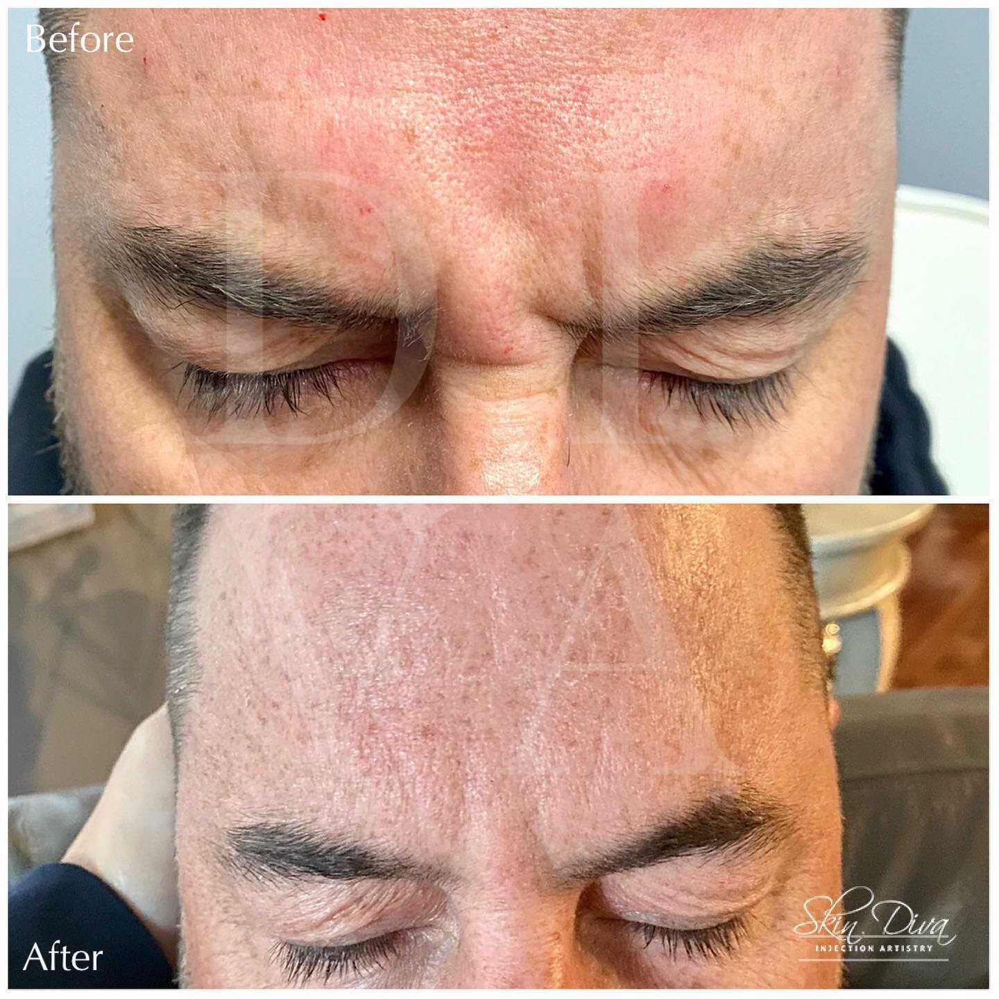 Before and after frown line treatment between the eyebrows
