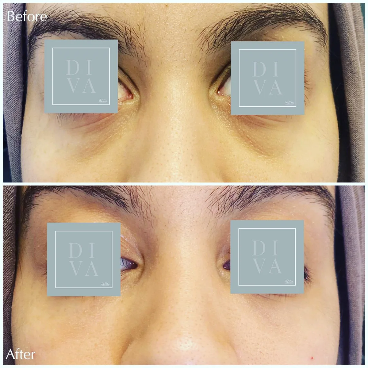 Before and after under-eye rejuvenation, close-up view