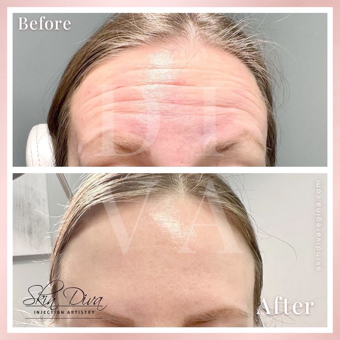 Before and after forehead line treatment with wrinkles softened