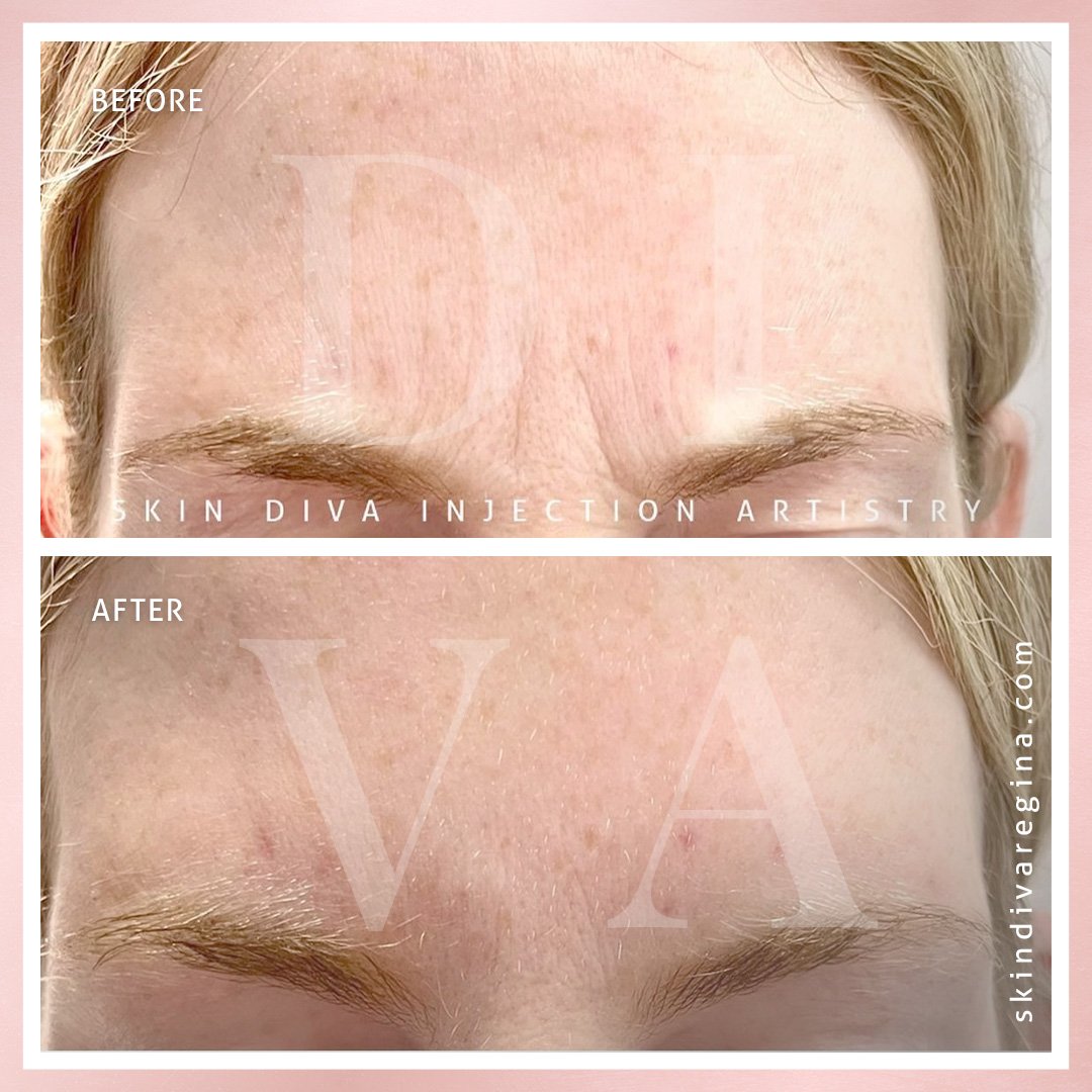 Before and after forehead and brow line treatment