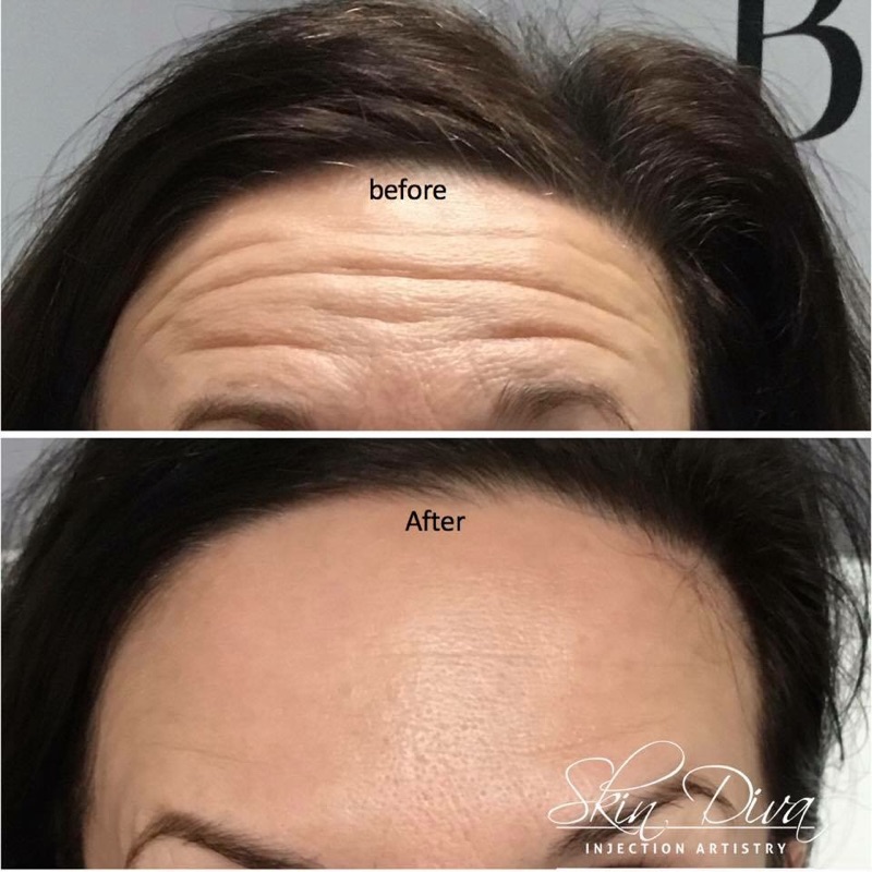 Before and after forehead wrinkle treatment, front view
