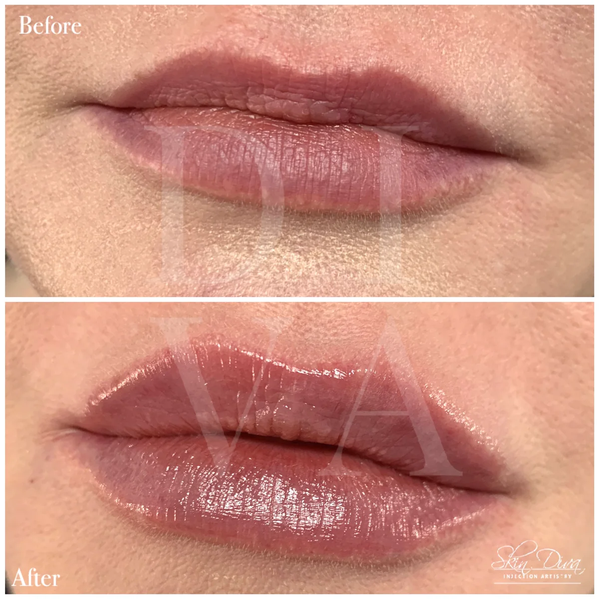 Before and after lip filler treatment with fuller lower lip