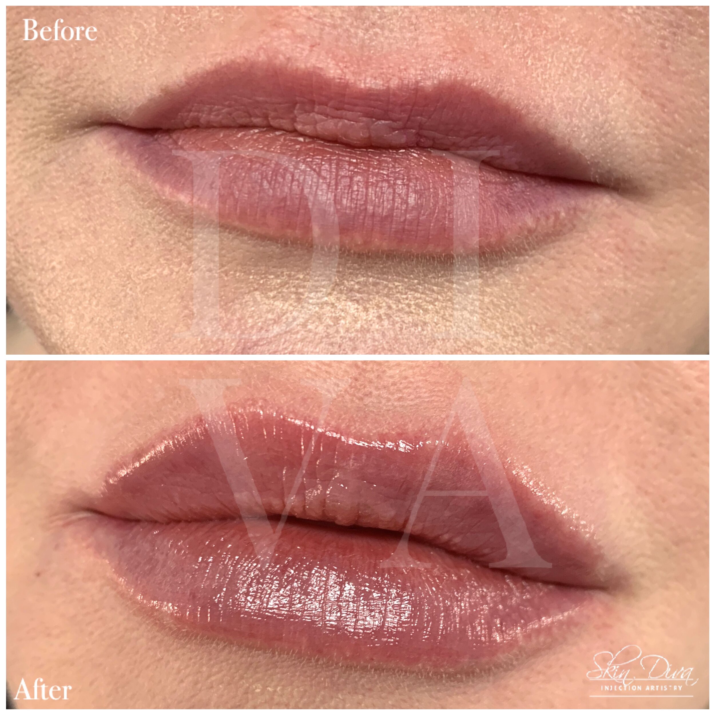 Before and after lip filler treatment with fuller lower lip