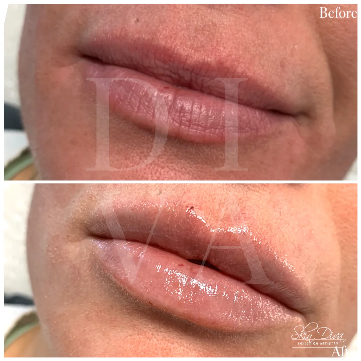 Before and after lip filler treatment with added definition