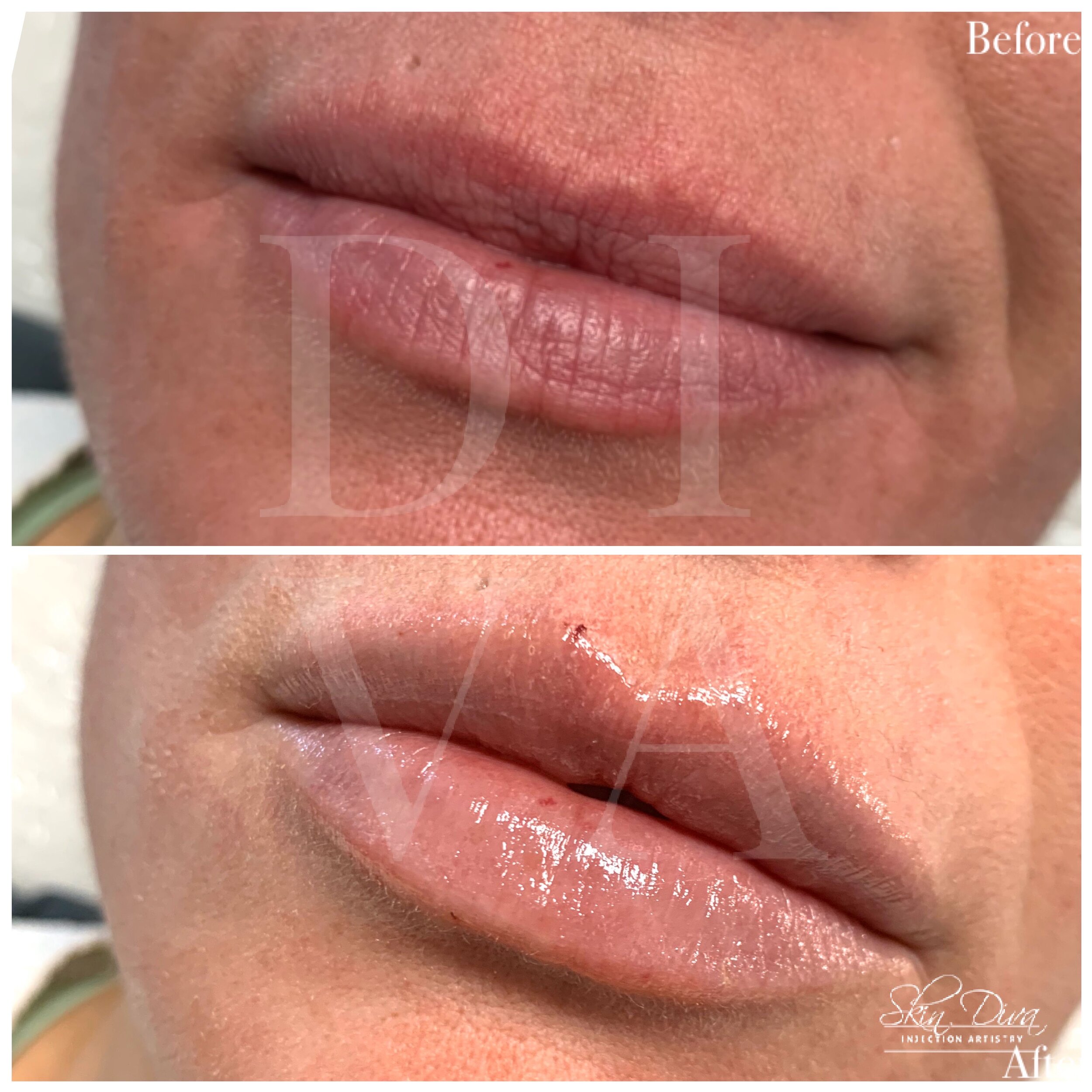 Before and after lip filler treatment with improved shape and volume
