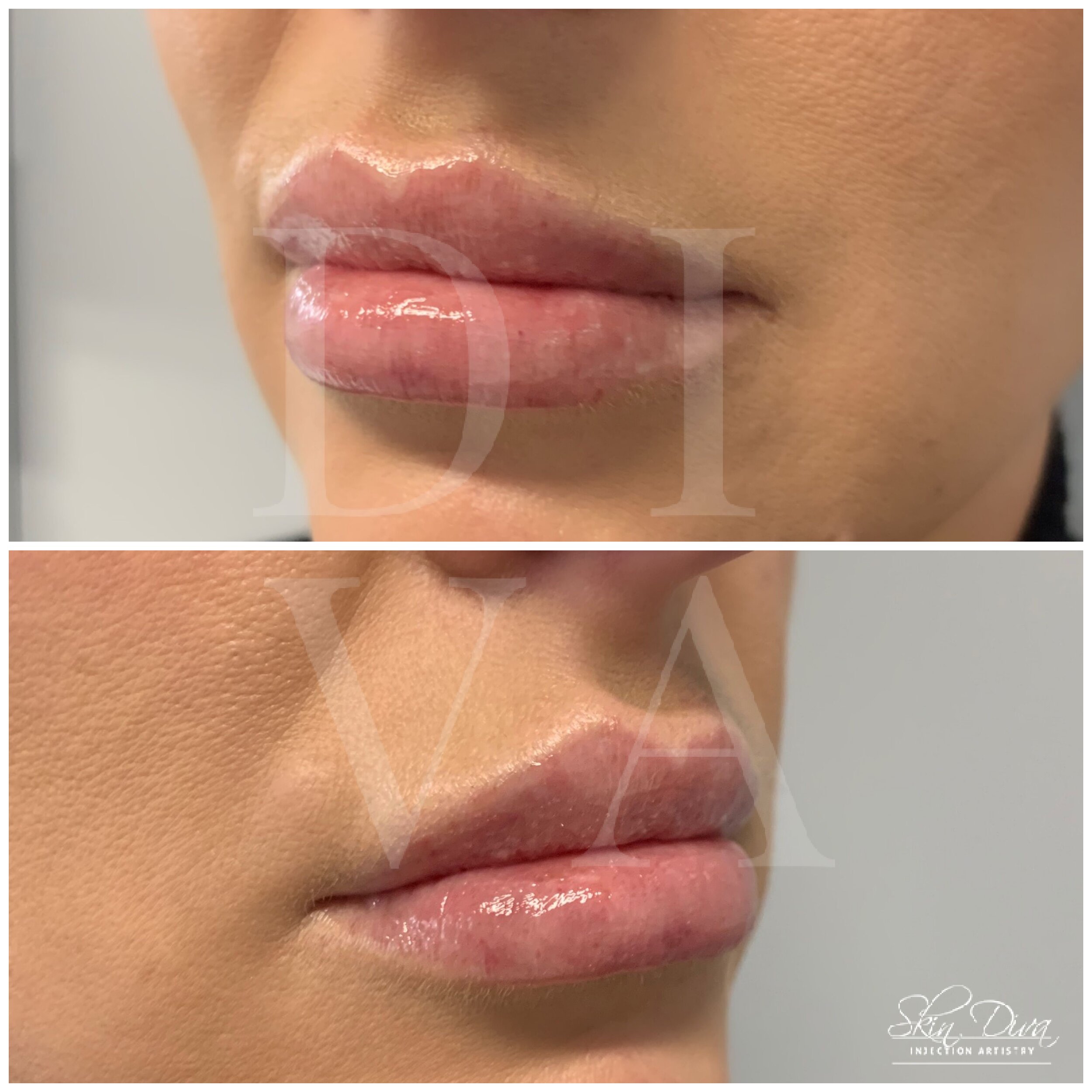 Before and after lip filler treatment, front view