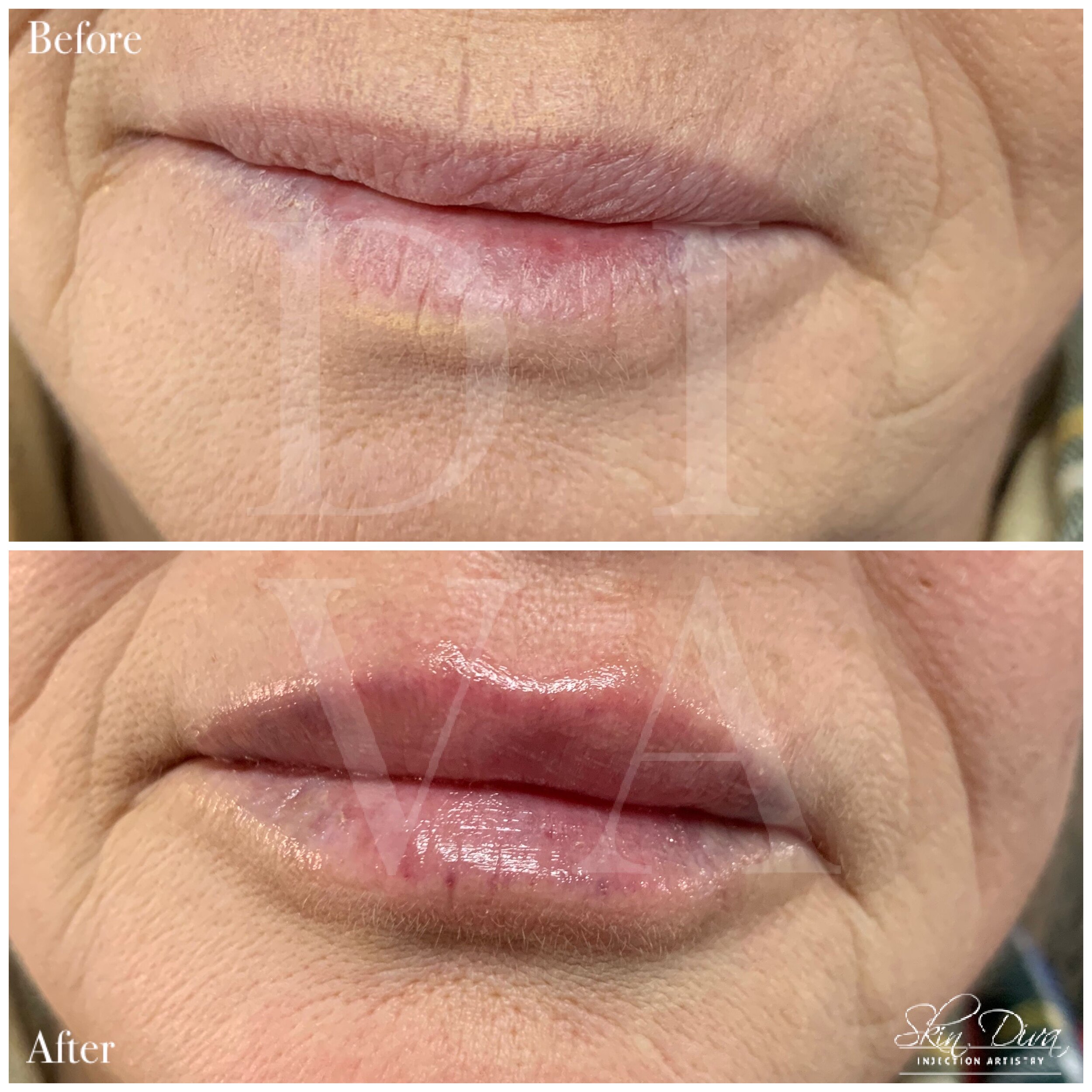Before and after lip filler treatment, side angle