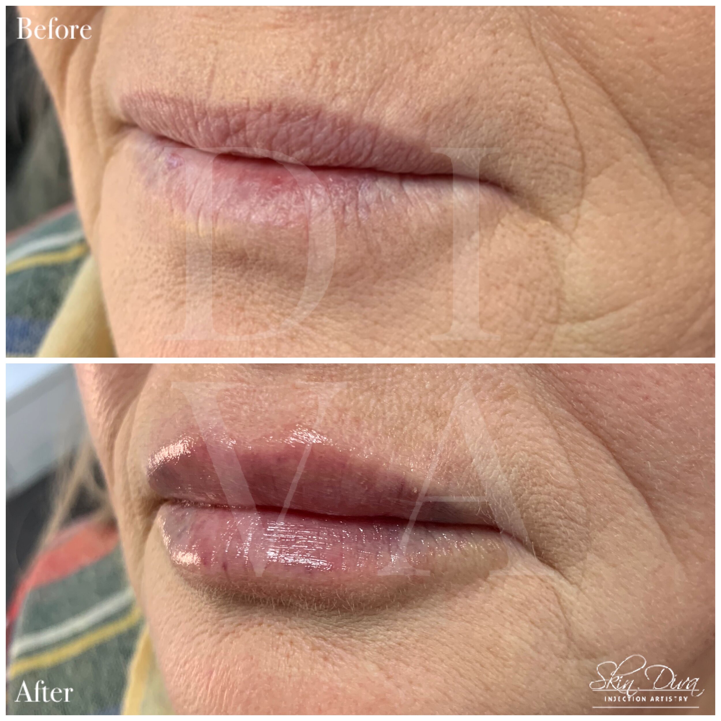 Before and after lip enhancement on mature lips