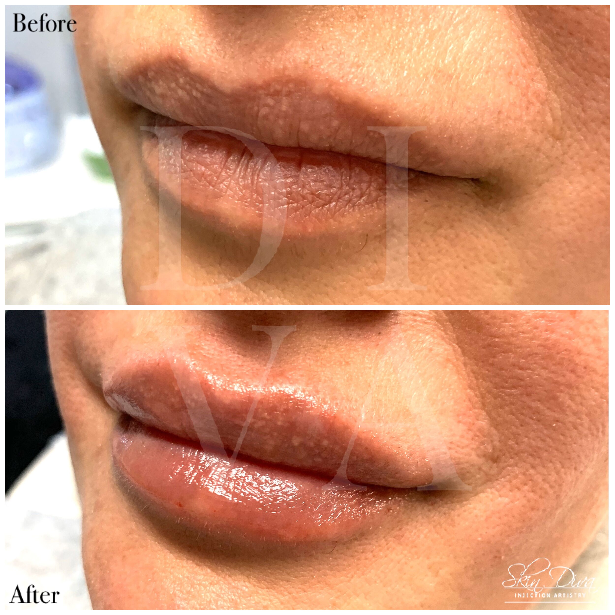 Before and after lip filler treatment, angled view